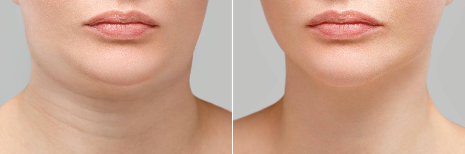 double chin reduction