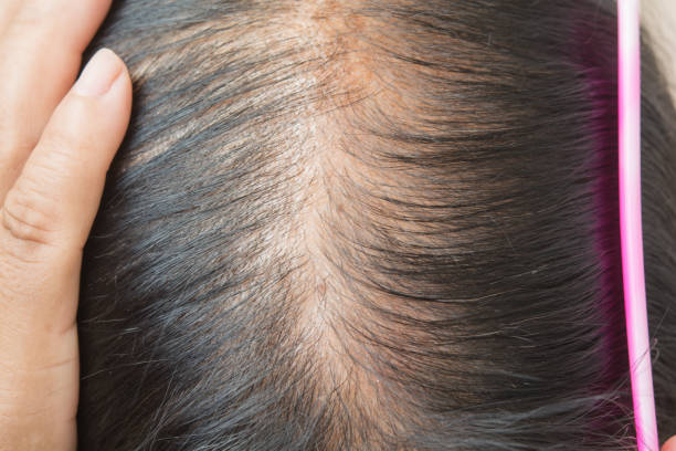 Hair Loss Treatment in Hanamkonda | Hair Loss Trico Scalp Treatment