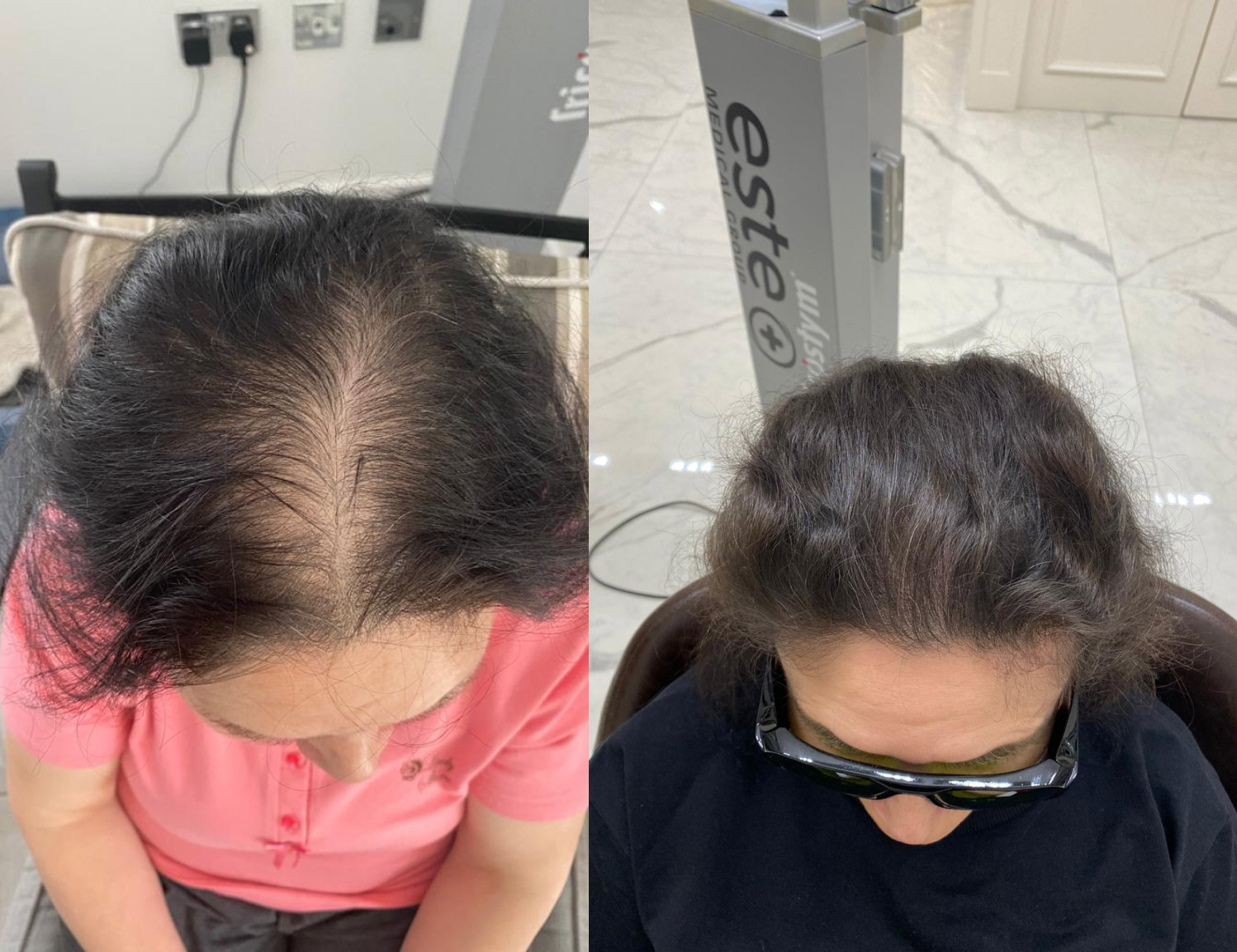 Laser Hair Treatment in Hanamkonda 's New Look Aesthetics  Clinic