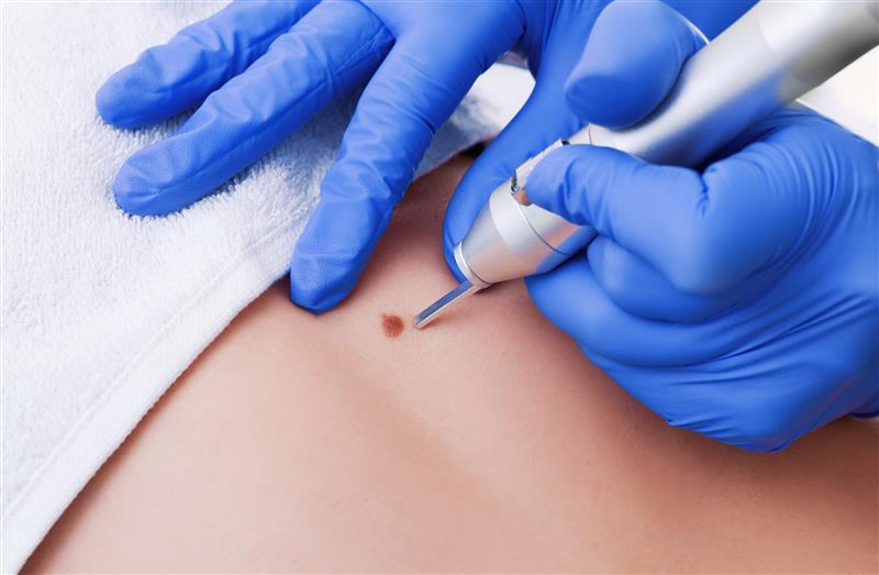 Mole Removal Treatment