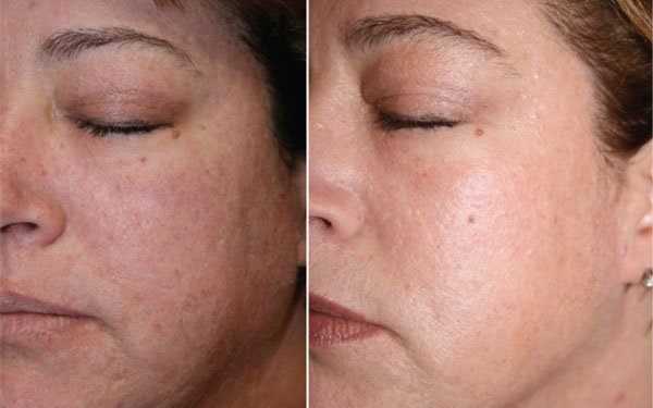 Reduced Pigmentation After Facial Treatment