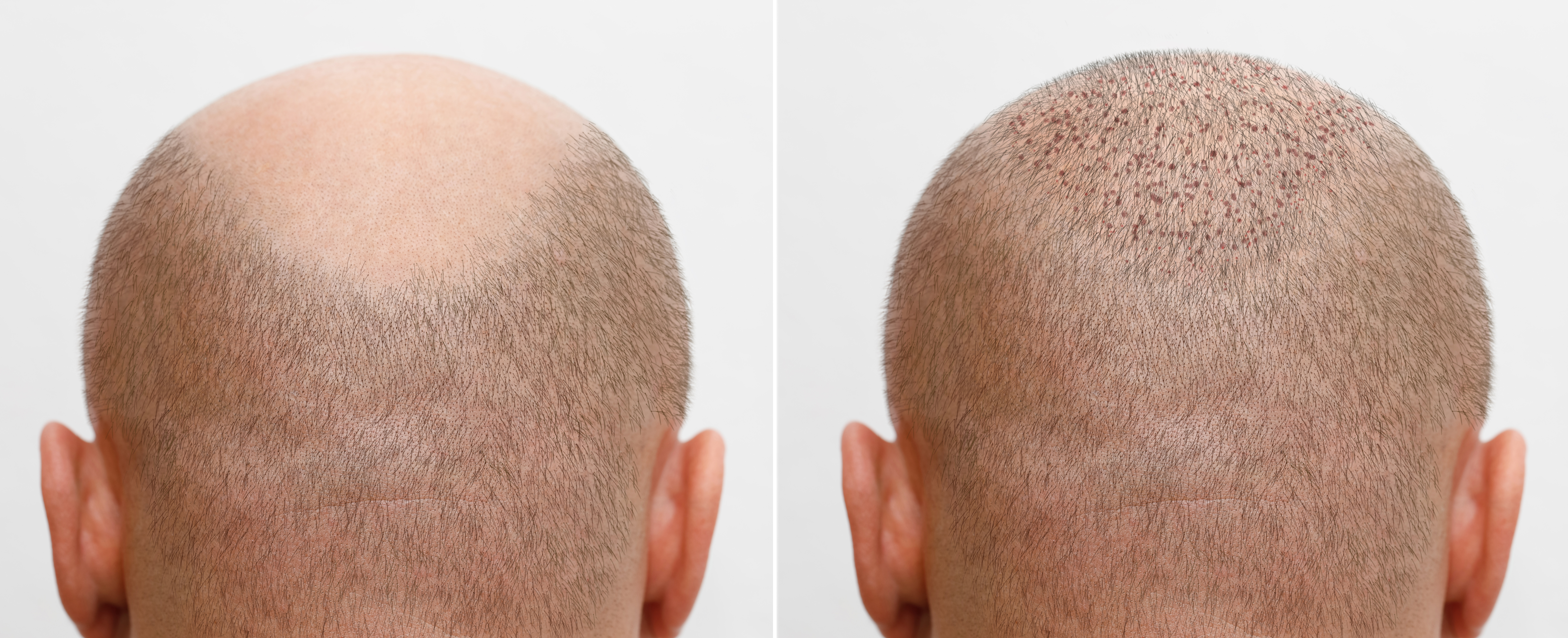 Scalp micropigmentation procedure