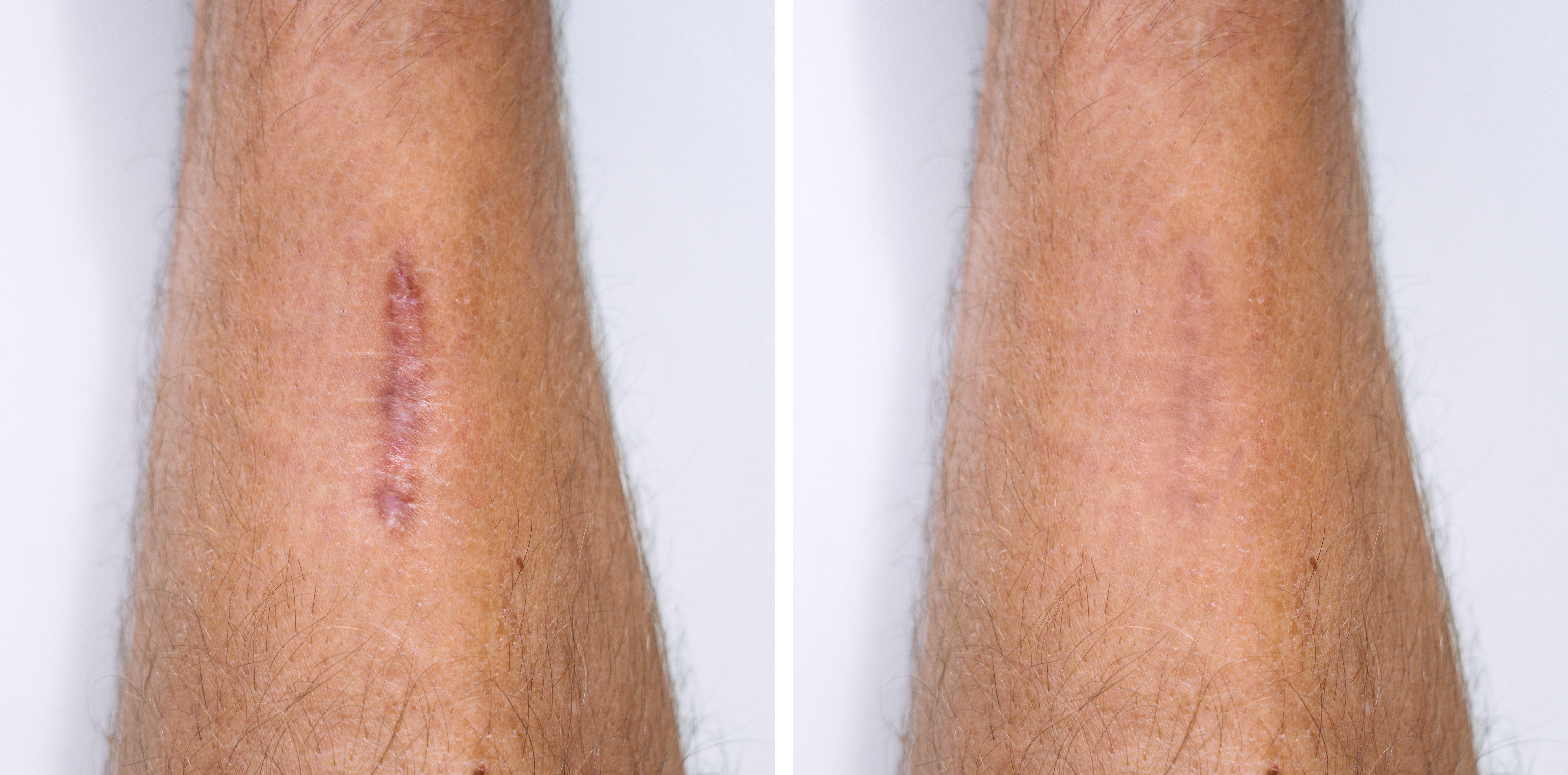 Scar Revision Surgery