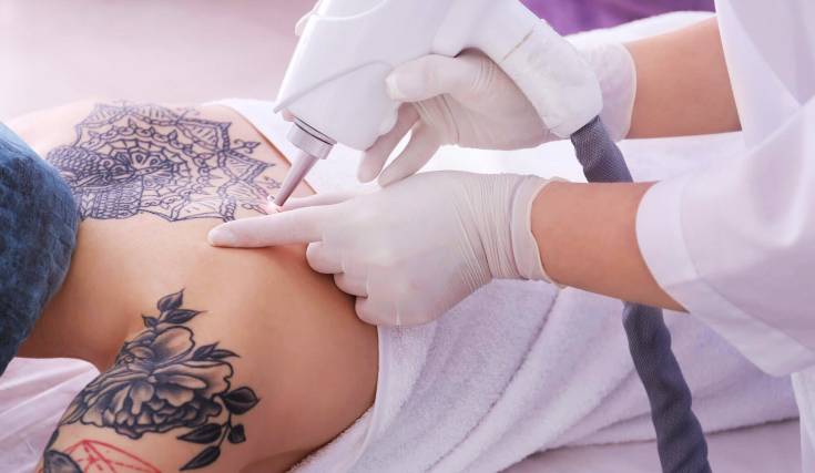 10 Things to Know Before Getting Laser Tattoo Removal  RealSelf News