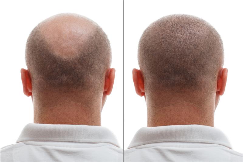 Advanced Hair Transplant Results