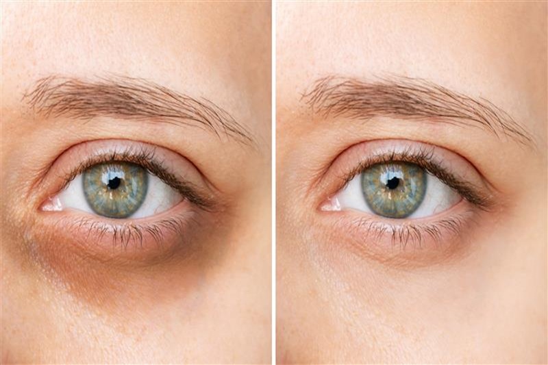 Dark Circle Reduction