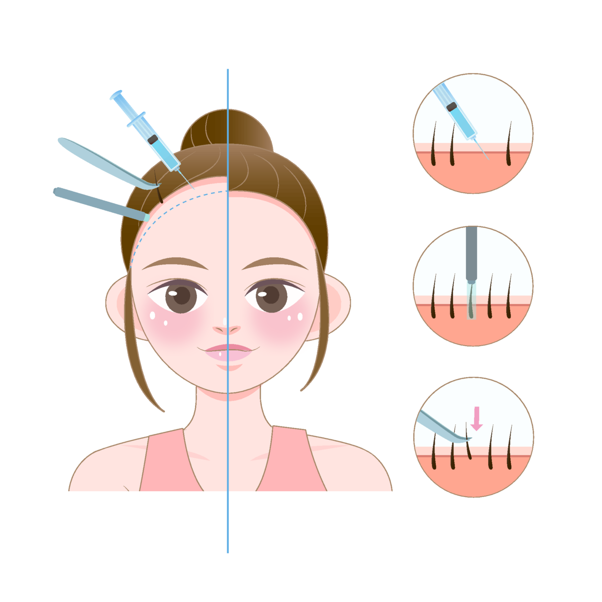 Hair Transplant Treatment