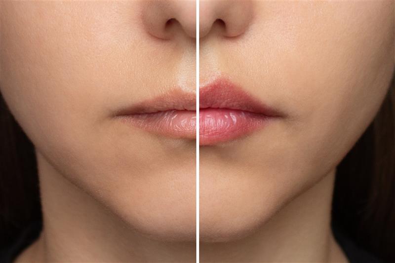Natural Looking Lip Fillers
