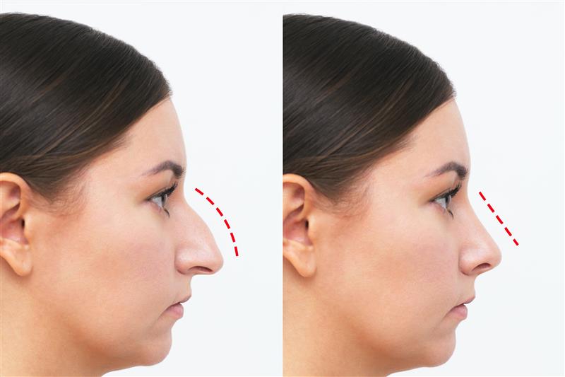 Nose Reshaping Surgery