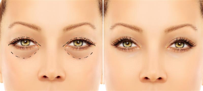 Blepharoplasty Treatmment