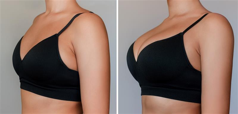 cosmetic breast enhancement surgery