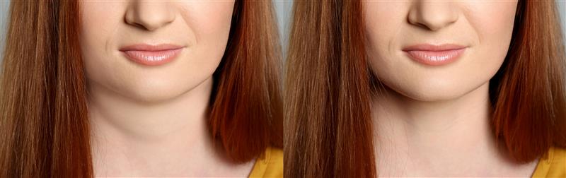 Buccal Fat Removal
