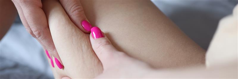 Advanced cellulite reduction procedure for toned legs