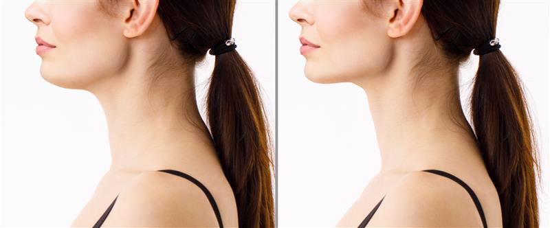 non-surgical chin and jawline Cheekbone Enhancement and contouring treatment