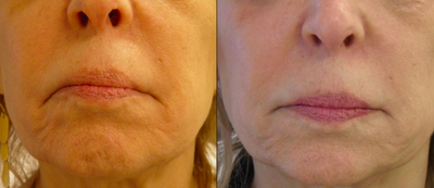 Before-and-After Comparison of Facial Skin