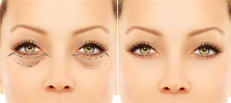 Under Eye Dark Circle Removal