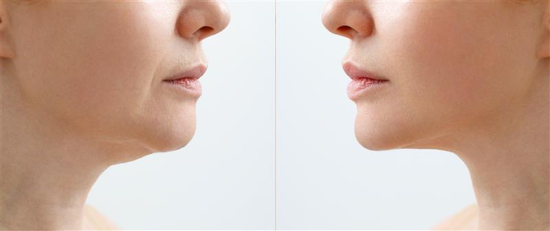 Orthognathic Surgery for Jaw Correction