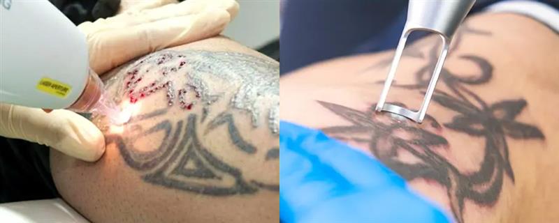 Laser Tattoo Removal Treatment