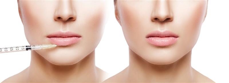 Before and after lip filler injection
