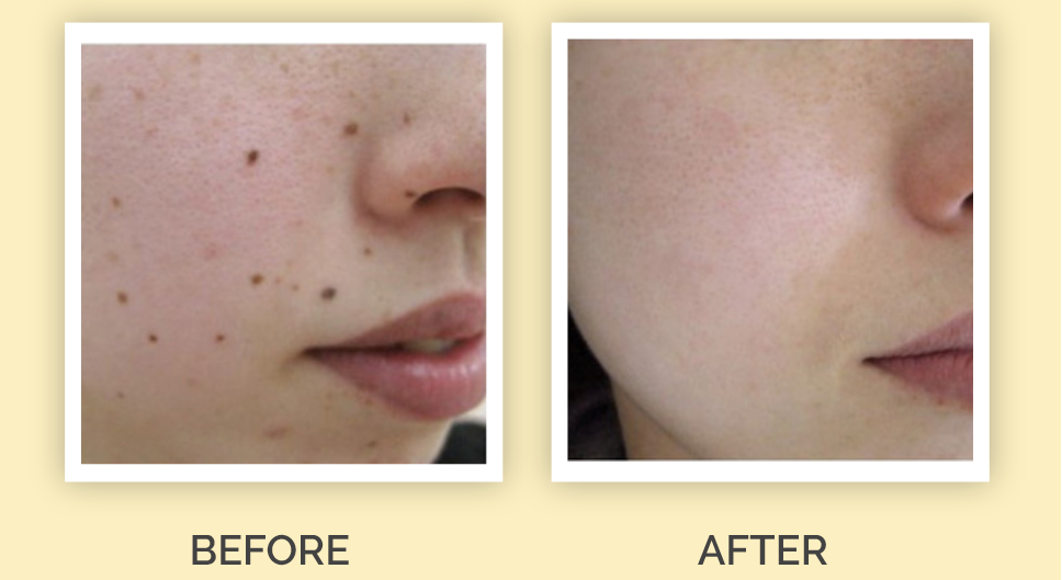 Before and after mole Skin tags Wart
 removal