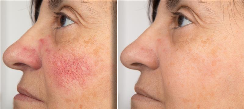 Pigmentation and Melasma Treatment in Hyderabad