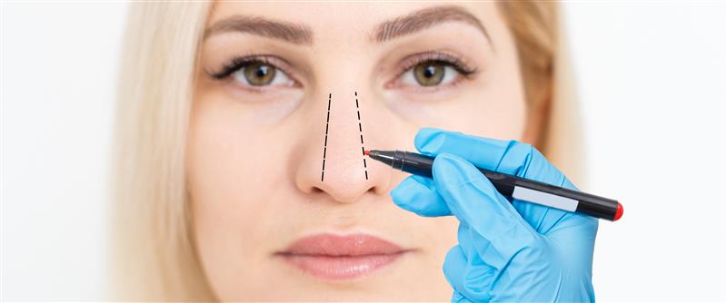 Rhinoplasty procedure