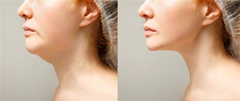 Skin Tightening Treatment