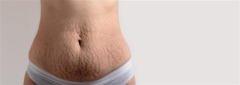 Stretch mark Correction treatment