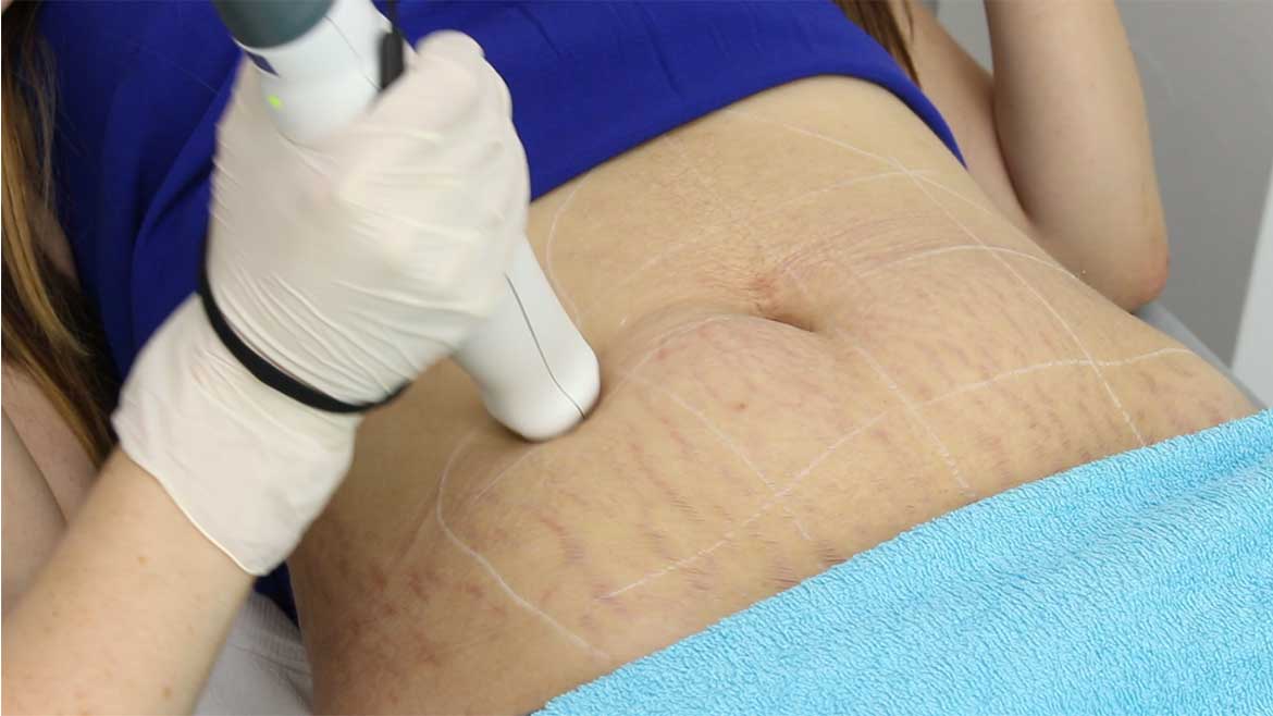 Stretch Mark Reduction Treatment